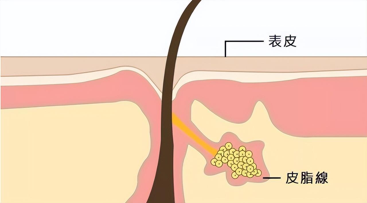 怎么让毛孔变小变干净，3个缩小毛孔最有效的方法