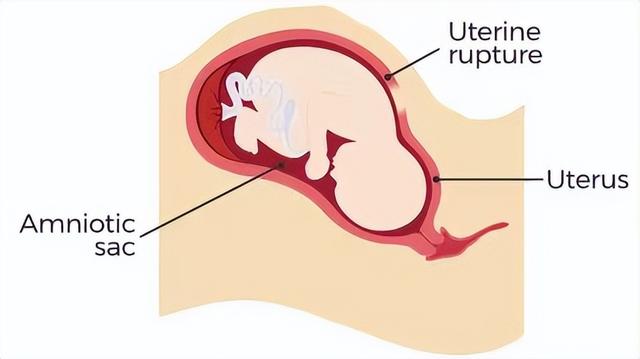 先兆子宫破裂四大表现，子宫最薄1mm可以走路吗（孩子生到一半，子宫破了）