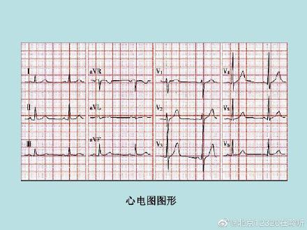 心电图报告怎么看，心电图怎么看（如何读懂心电图）