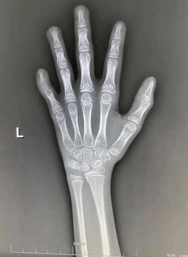 ba什么意思，跋什么意思（内分泌科医生和你讲讲骨龄那些事）