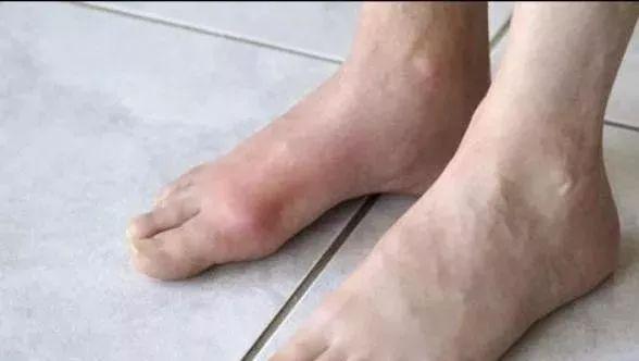 脚发痒是什么原因,晚上脚痒白天不痒是怎回事(脚部出现9种症状)