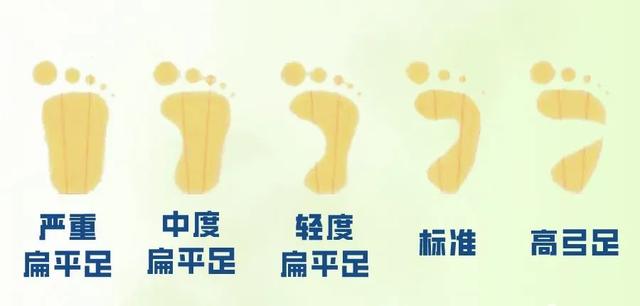 如何纠正外八脚走路姿势，外八如何矫正走路姿势（让家长担心的“小儿扁平足”）