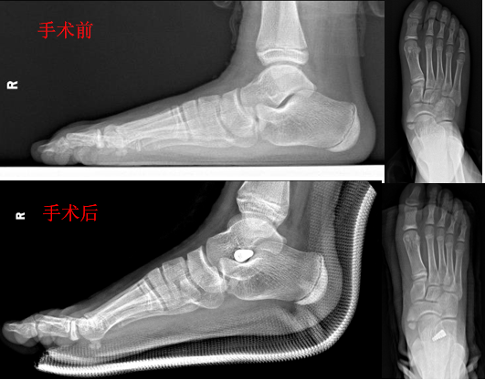如何纠正外八脚走路姿势，外八如何矫正走路姿势（让家长担心的“小儿扁平足”）