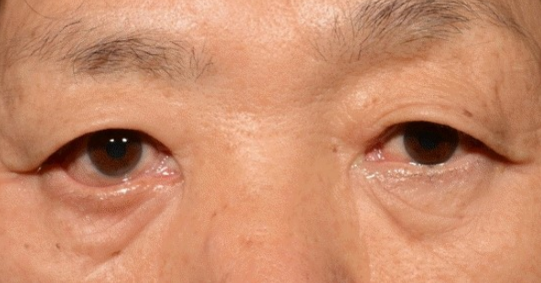 三白眼什么意思，什么是三白眼（原来下三白眼不只是天生的）