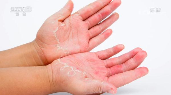 手掌脱皮是什么原因，手掌脱皮是什么原因用什么药（我的手到底“惹了谁”）