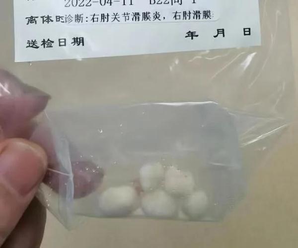 肘关节疼痛的原因和治疗方法，肘关节疼痛的原因和治疗方法图解（原来里面长了5颗“珍珠”）