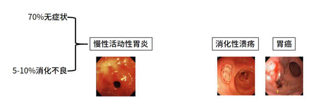 幽门螺杆菌hp值多少正常，幽门螺杆菌感染“面面观”