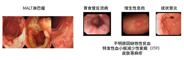 幽门螺杆菌hp值多少正常，幽门螺杆菌感染“面面观”