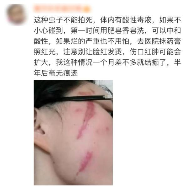 隐翅虫咬人后图片，隐翅虫咬后最有效的处理方法（这种虫子，毒液堪比硫酸）
