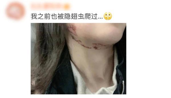 隐翅虫咬人后图片，隐翅虫咬后最有效的处理方法（这种虫子，毒液堪比硫酸）