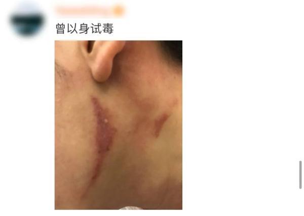 隐翅虫咬人后图片，隐翅虫咬后最有效的处理方法（这种虫子，毒液堪比硫酸）