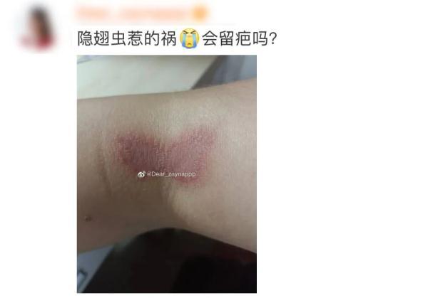 隐翅虫咬人后图片，隐翅虫咬后最有效的处理方法（这种虫子，毒液堪比硫酸）