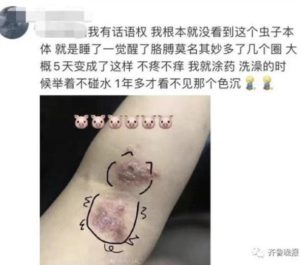 隐翅虫咬人后图片，隐翅虫咬后最有效的处理方法（这种虫子，毒液堪比硫酸）