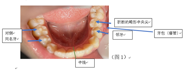 小孩磨牙是怎么回事，孩子磨牙是怎么回事（10到12岁的儿童要注意）