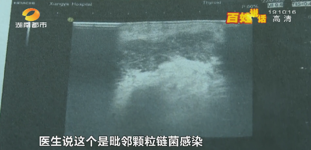 洗牙后悔一辈子，为什么很多人后悔洗牙（长沙一女士洁牙后后悔不已....）