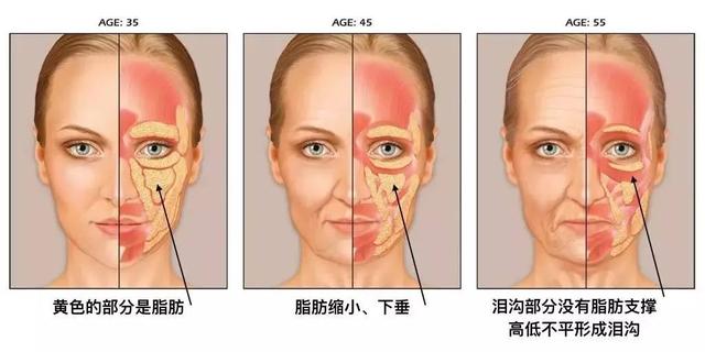 颧骨高怎么才能改善，高颧骨怎么改善（她们的颧骨怎么越来越高了）