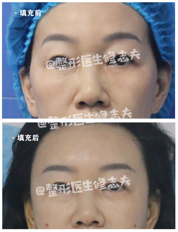 颧骨高怎么才能改善，高颧骨怎么改善（她们的颧骨怎么越来越高了）