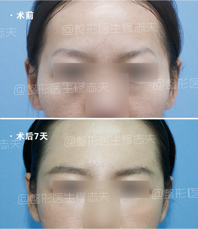 颧骨高怎么才能改善，高颧骨怎么改善（她们的颧骨怎么越来越高了）