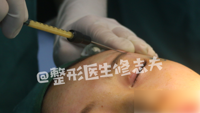 颧骨高怎么才能改善，高颧骨怎么改善（她们的颧骨怎么越来越高了）