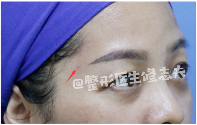 颧骨高怎么才能改善，高颧骨怎么改善（她们的颧骨怎么越来越高了）