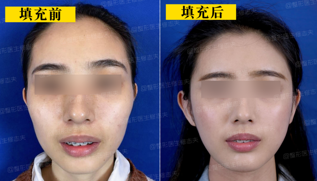 颧骨高怎么才能改善，高颧骨怎么改善（她们的颧骨怎么越来越高了）