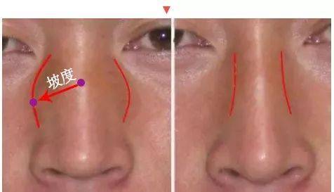 宽鼻翼面相,济南海峡整形分享鼻子过宽这样隆鼻才好看-相术-荣耀易学