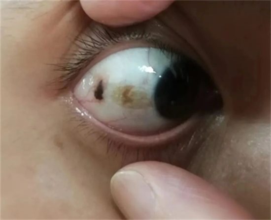 女生右眼眼白有痣非常人,相亲姑娘一句话让杭州小伙慌了神 - 玉三网