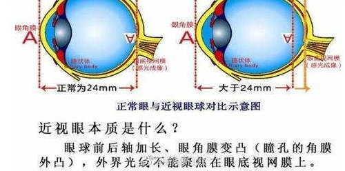 高度近视眼球突出可不可以手术，眼球突出还能做近视手术吗（女子近视3000度被迫摘除眼球）