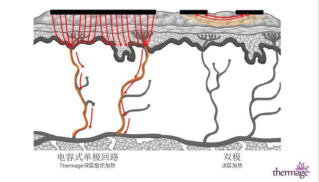 热玛吉是什么，美容级别的热玛吉是什么（想做热玛吉？先看看这篇再说）