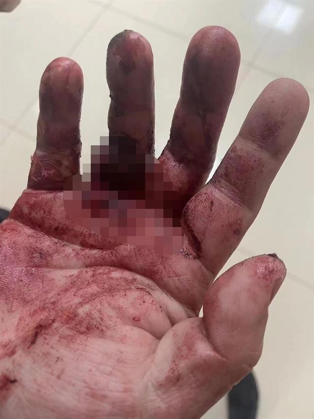 手里扎刺取出妙招，手上扎刺还在用针挑（武汉江夏民警代涛以手挡刀救自残轻生女子）