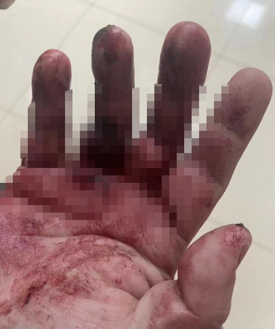 手里扎进小刺了弄不出来怎么办，手上扎进小刺很疼却挑不出来怎么办（他被连刺三刀，仍不松手……）