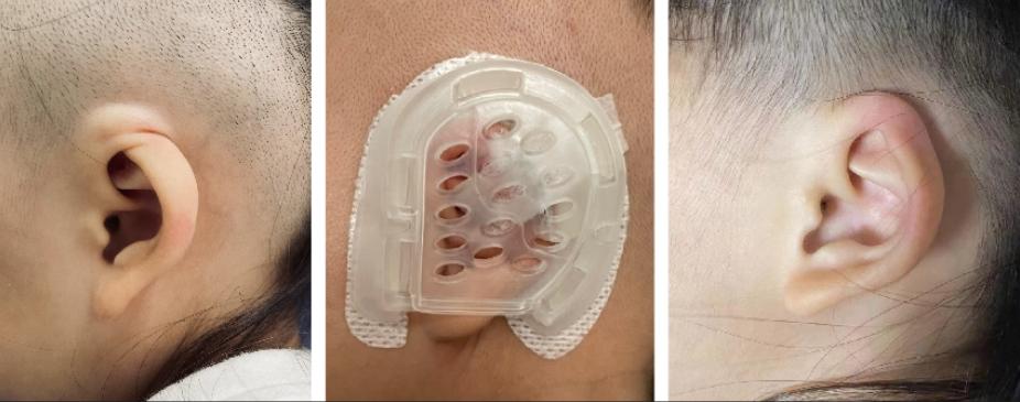 隐耳无创矫形治疗前中后吴旋介绍,隐耳亦称埋没耳,属先天性耳廓形态