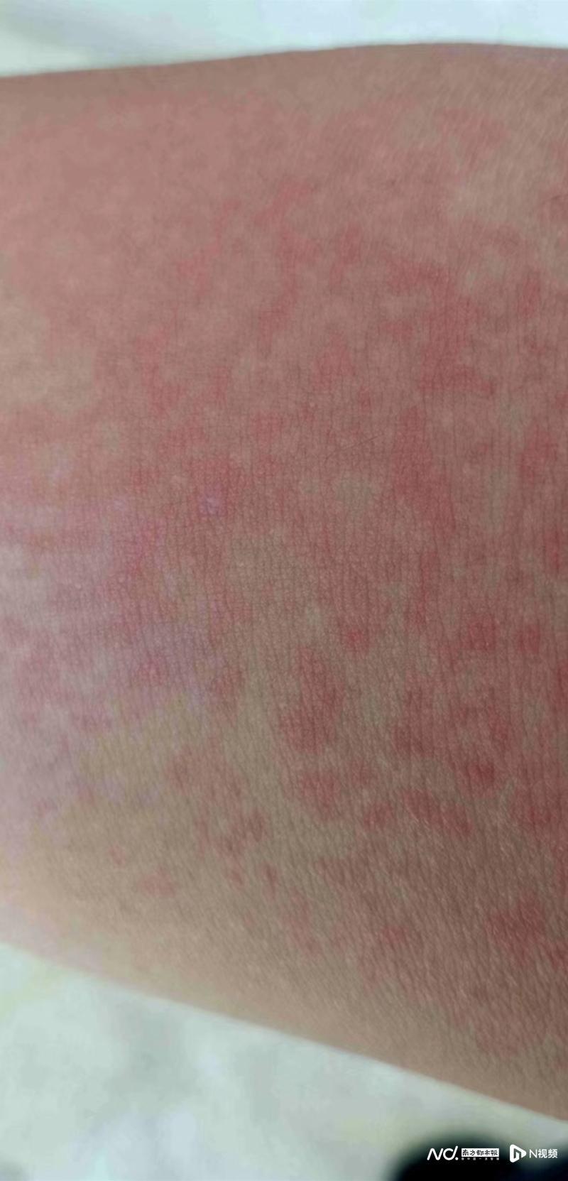 脱毛膏最好用的是哪几款，有产品试用后出现皮肤红肿刺痛